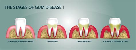 gum disease treatment near me|dentists that treat periodontal disease.